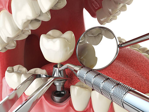 Best Emergency Dentist for Lost Fillings or Crowns in Kendallville, IN